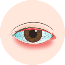 希瑪眼科中心_眼表疾病_眼角膜疾病