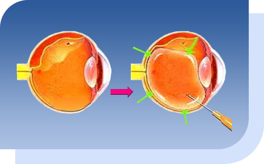 希瑪眼科中心_視網膜脫落治療_充氣性視網膜固定術